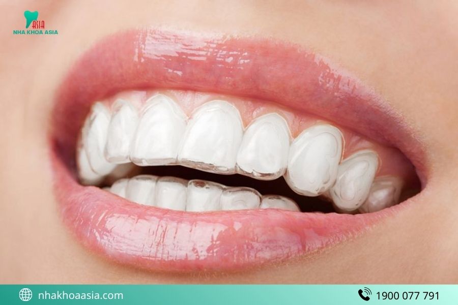 Niềng răng Invisalign