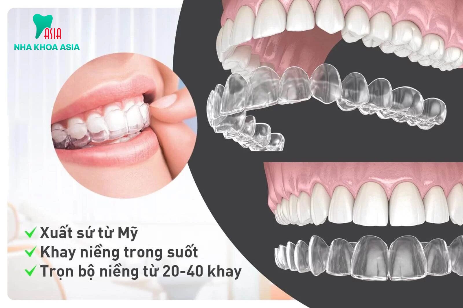 Niềng răng mắc cài trong suốt là gì?