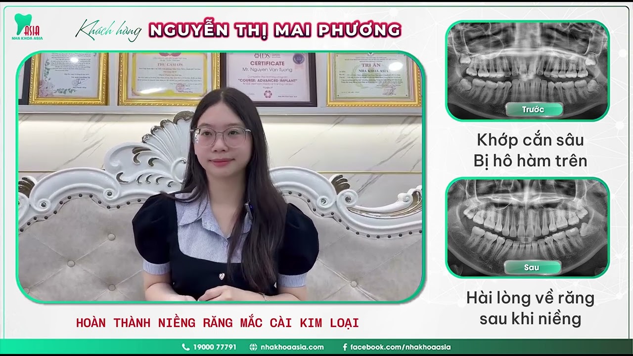 Niềng răng thẩm mỹ giá bao nhiêu tiền?