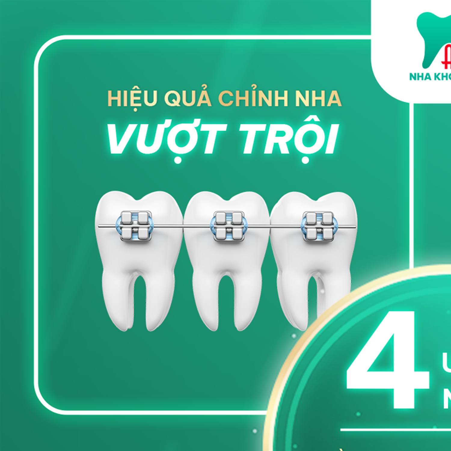 Niềng răng mắc cài tự khóa hiệu quả vượt trội