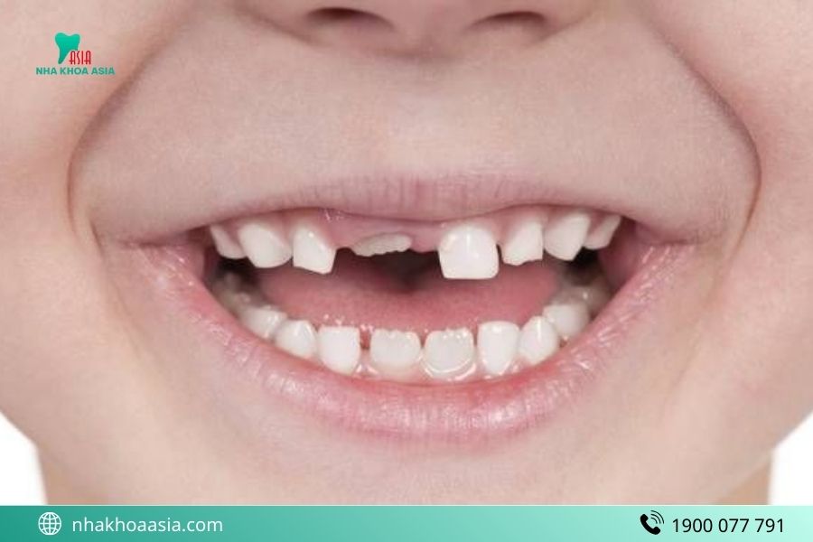 Niềng răng trẻ em thời điểm nào tốt