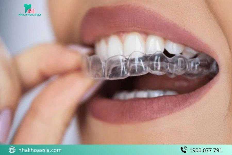 Niềng răng trong suốt