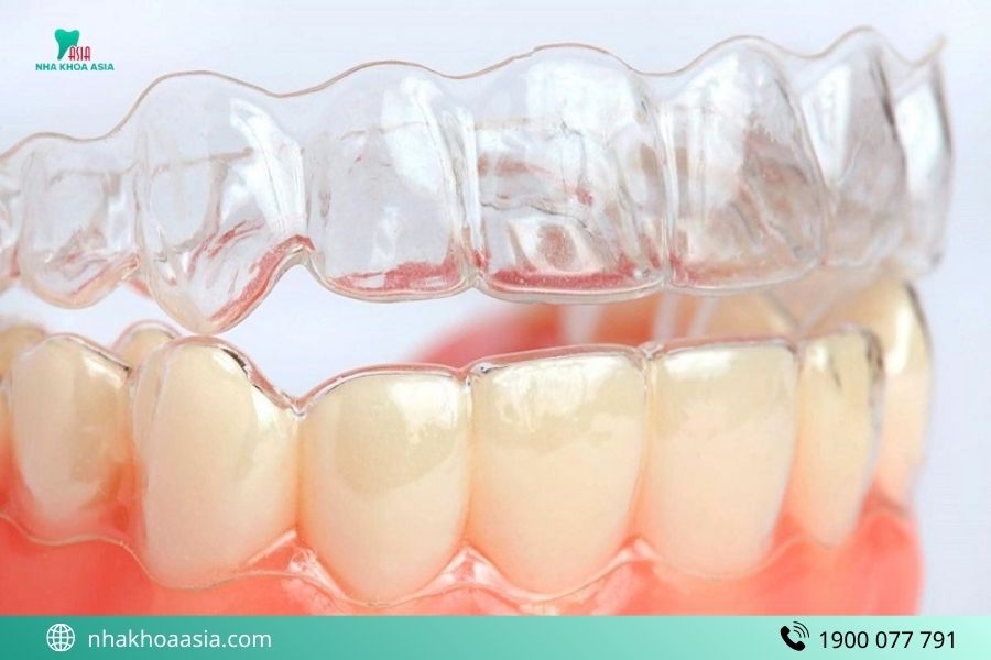 Niềng răng trong suốt ăn uống như thế nào?