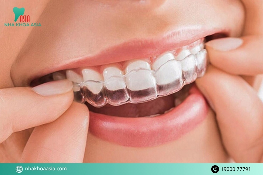 Ai phù hợp với niềng răng trong suốt ClearCorrect?