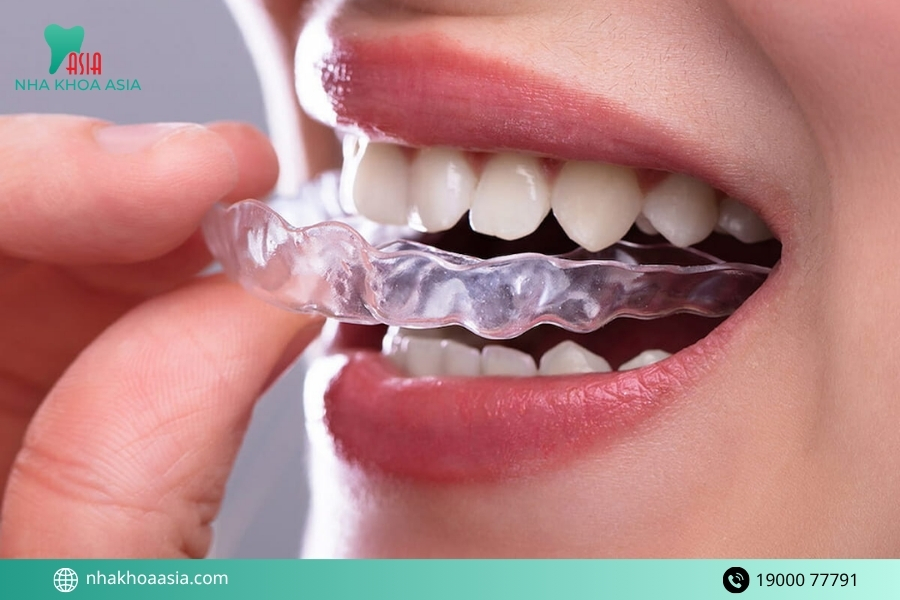 Những trường hợp cần cân nhắc kỹ trước khi niềng ClearCorrect