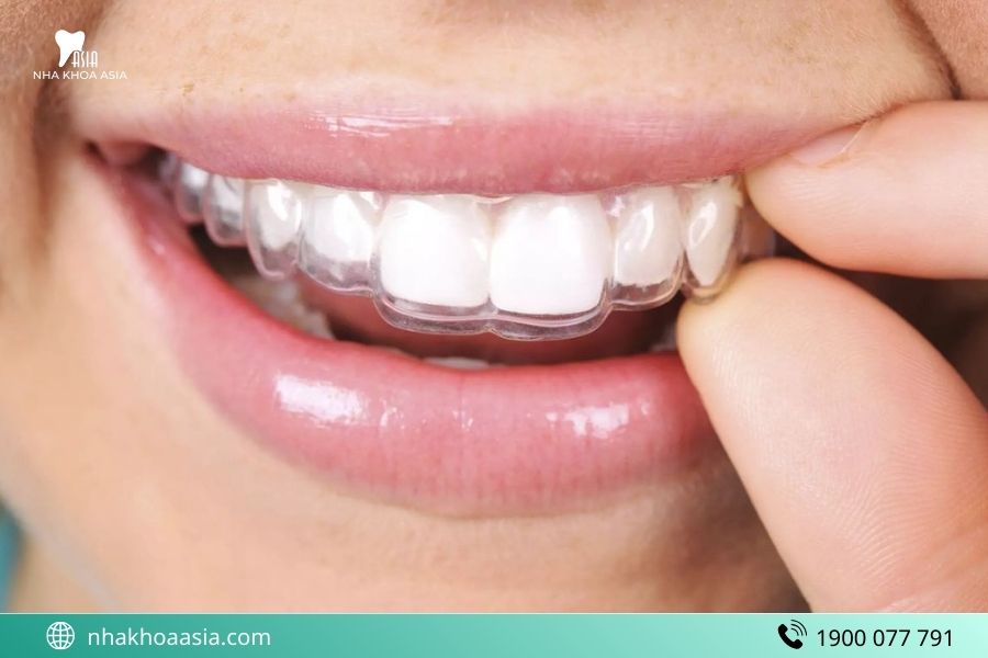 Niềng răng trong suốt là gì?