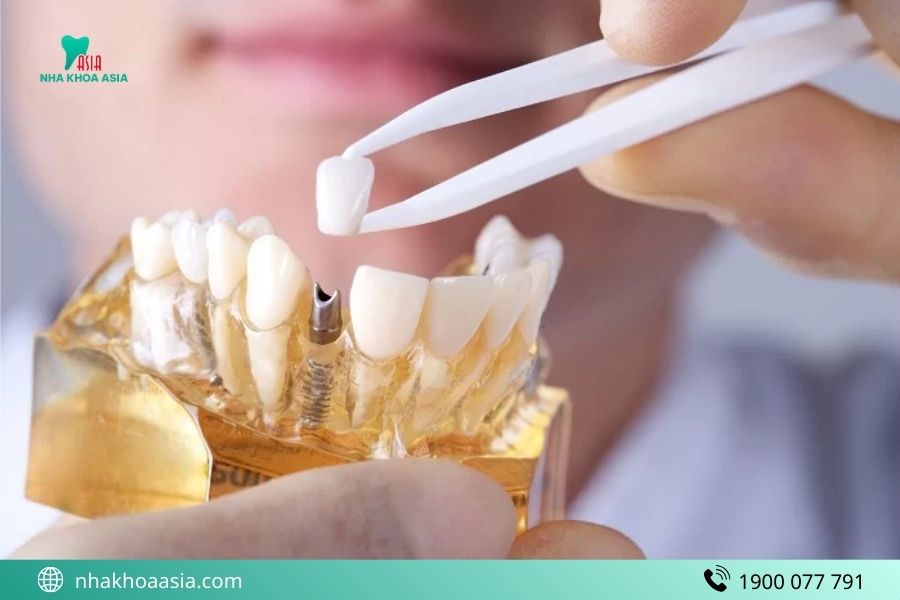 Phương pháp cấy ghép Implant