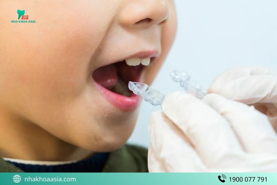 Các phương pháp niềng răng phổ biến nhất hiện nay