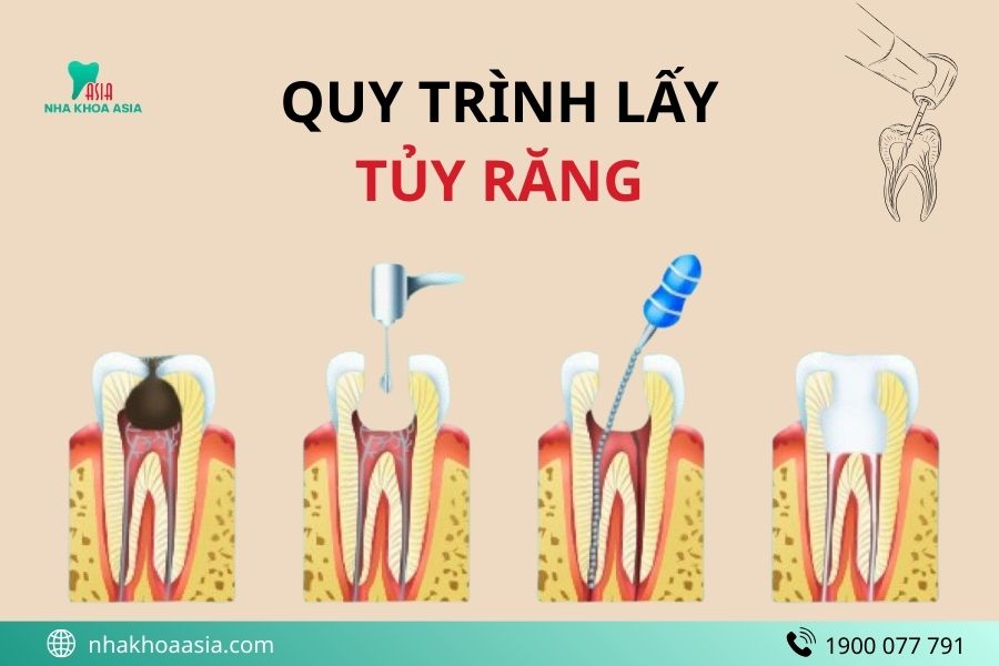 Quy trình lấy tủy răng lần 2