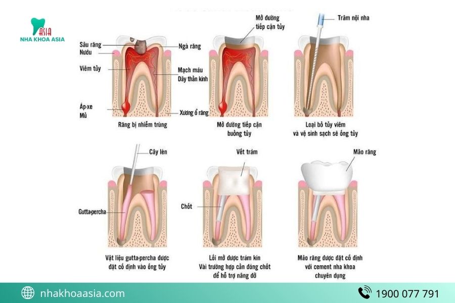 Quy trình lấy tủy răng