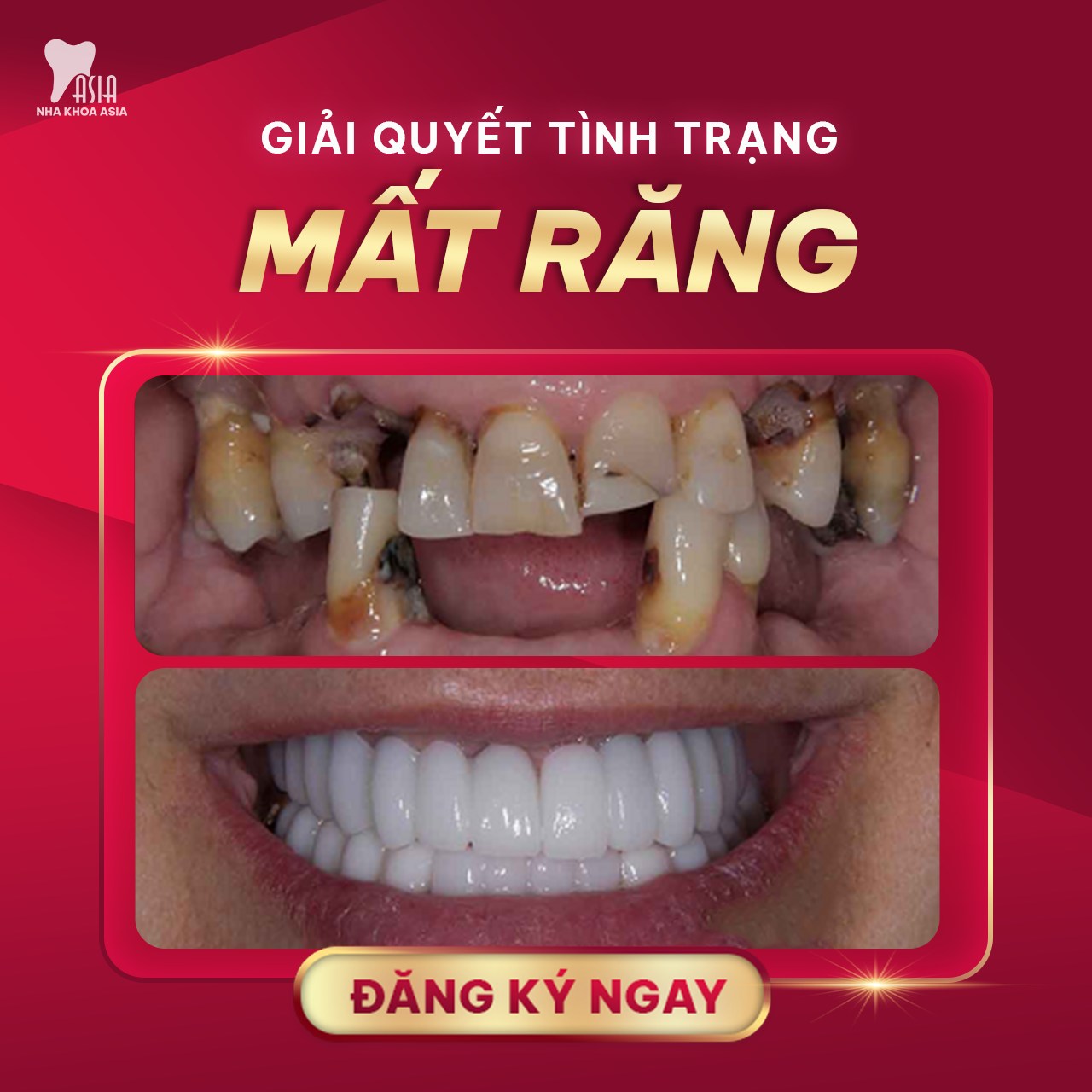 Gãy răng là một tình trạng đau đớn và lo lắng