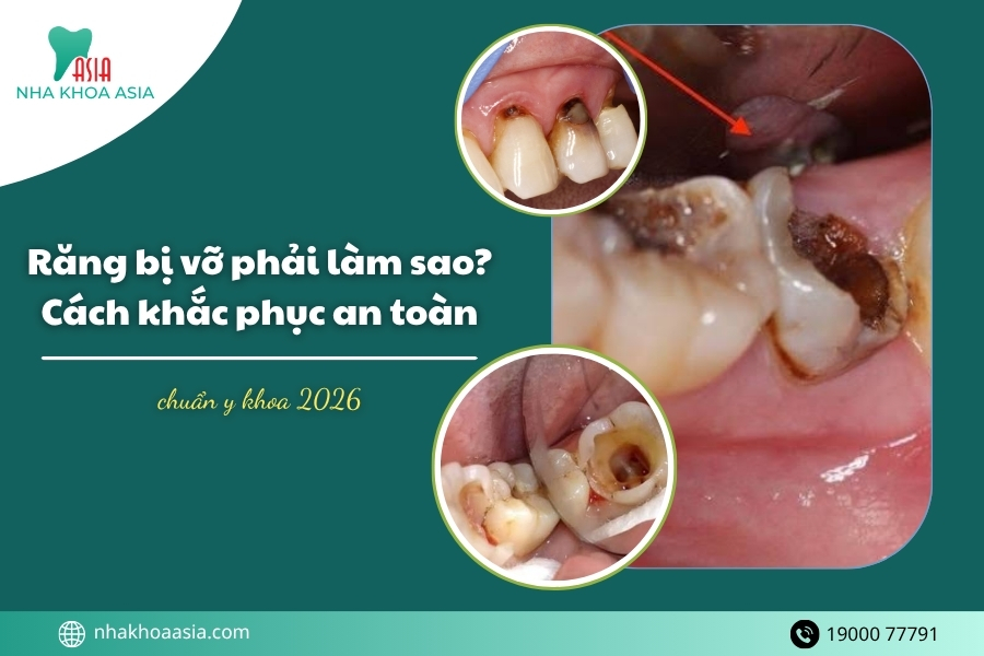 Răng bị vỡ phải làm sao? Cách khắc phục an toàn chuẩn y khoa 2026