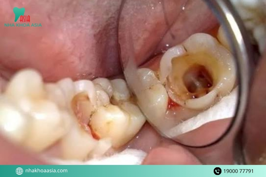Vì sao bạn nên khắc phục tình trạng răng bị vỡ càng sớm càng tốt?