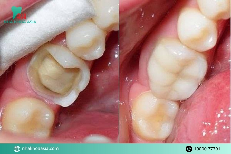 Những trường hợp răng bị vỡ cần đến nha khoa ngay