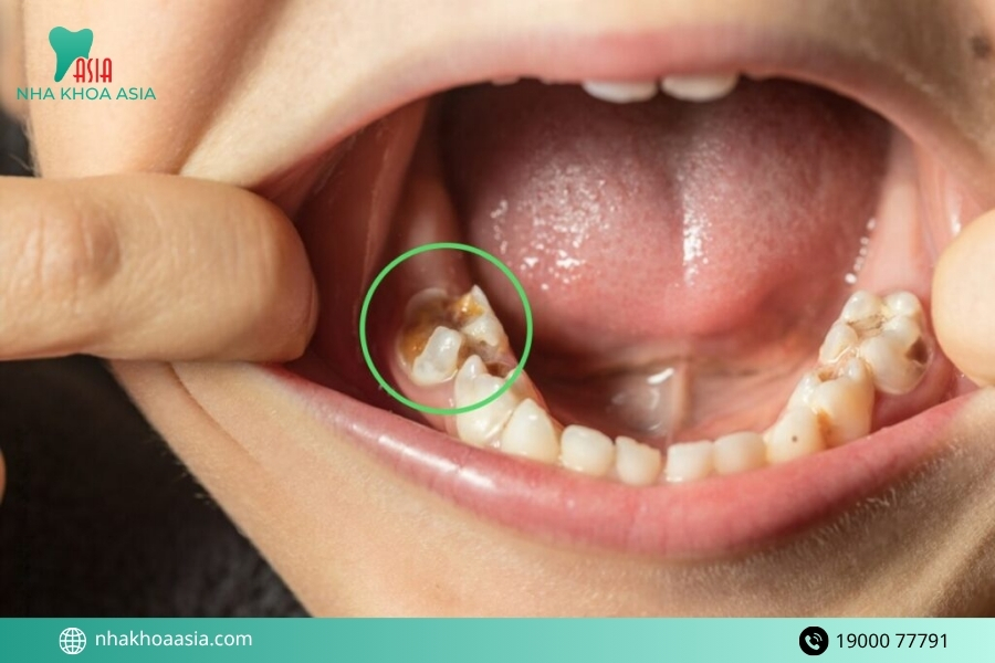 Răng bị vỡ có giữ lại được không hay phải nhổ?