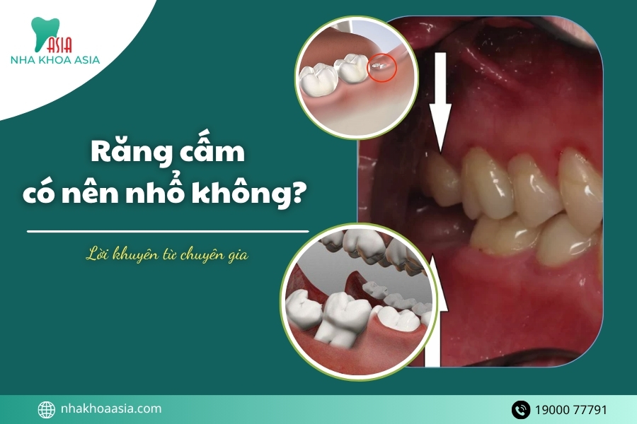 Răng cấm có nên nhổ không? Lời khuyên từ chuyên gia chuẩn y khoa