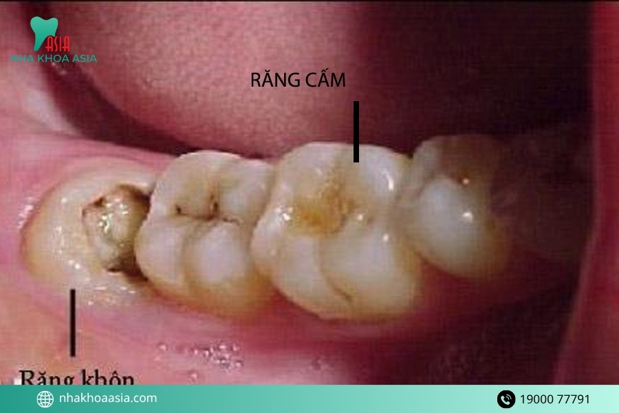 Răng cấm có phải là răng khôn không?