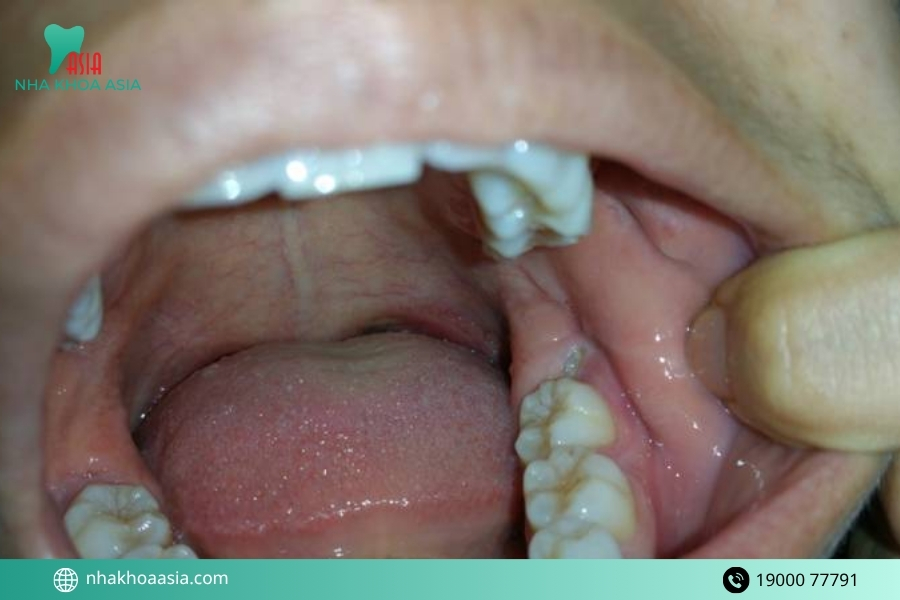 Vì sao bạn cần cân nhắc thật kỹ trước khi nhổ răng cấm?