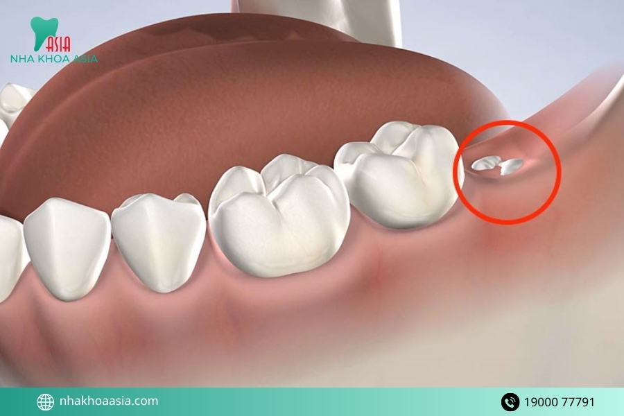 Những trường hợp chuyên gia chỉ động không nên nhổ răng cấm
