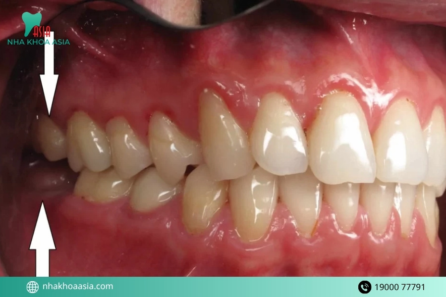 Nhổ răng cấm xong có ảnh hưởng gì không? Những biến chứng có thể xảy ra