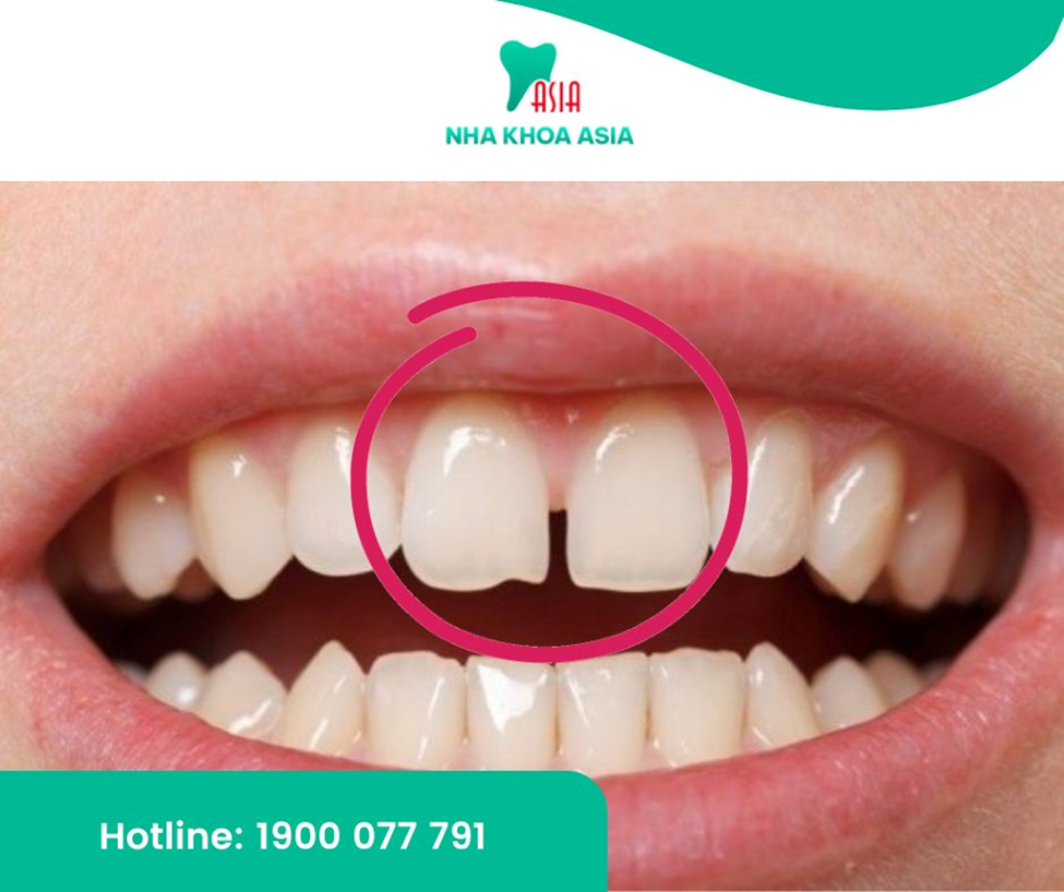 Răng cửa chính là chiếc răng nằm ở vị trí chính diện