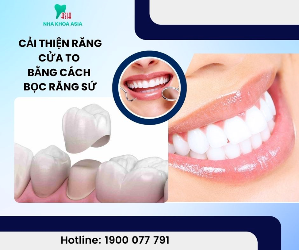 Răng cửa to có thể được chữa trị bằng phương pháp bọc răng sứ