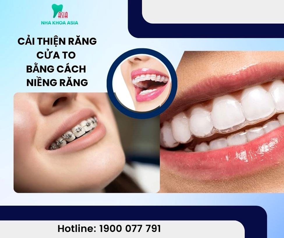 Phương pháp học niềng răng có thể thu nhỏ răng cửa to