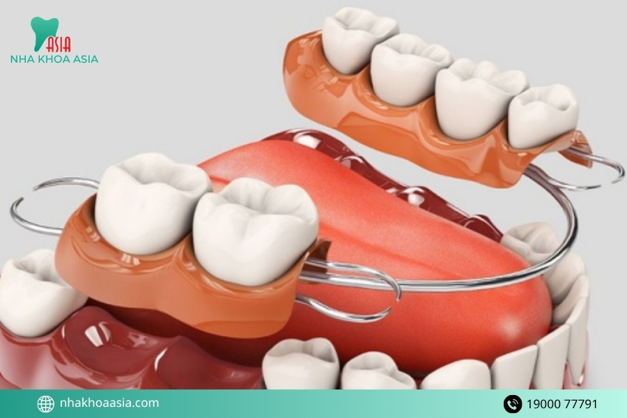 Răng giả tháo lắp có mấy loại?