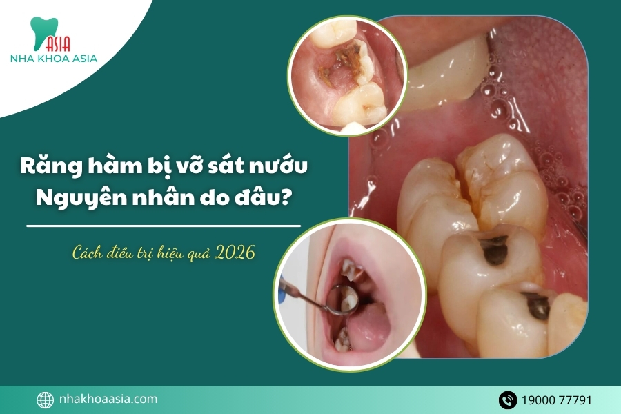Răng hàm bị vỡ sát nướu: Nguyên nhân & cách điều trị hiệu quả 2026