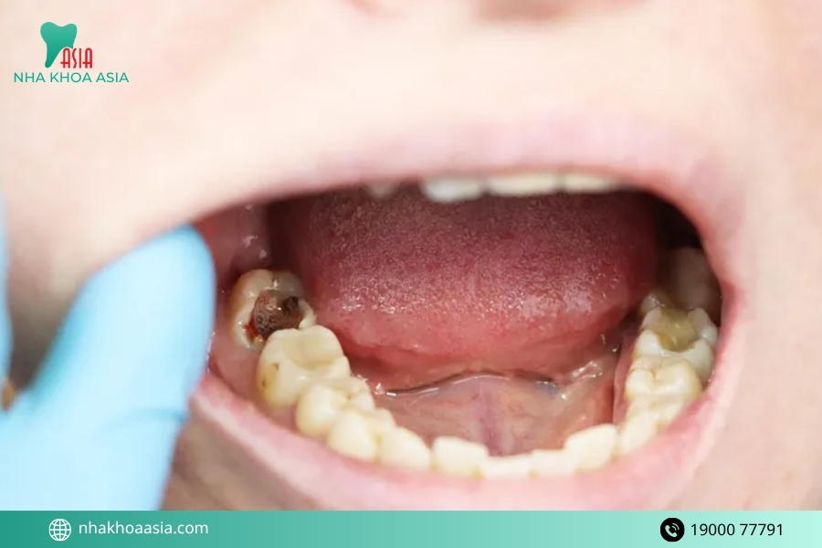 Răng hàm bị vỡ sát nướu có giữ được không?