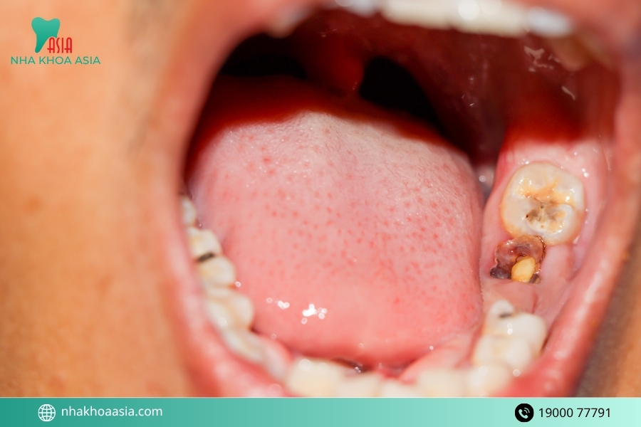  Những nguyên nhân dẫn đến răng hàm bị vỡ sát nướu