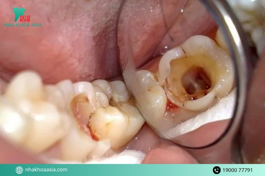 Điều trị răng hàm bị vỡ sát nướu mất bao lâu?