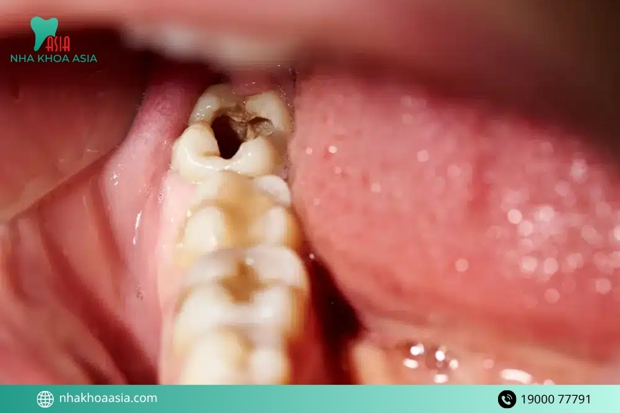 Chăm sóc sau khi điều trị răng hàm bị vỡ