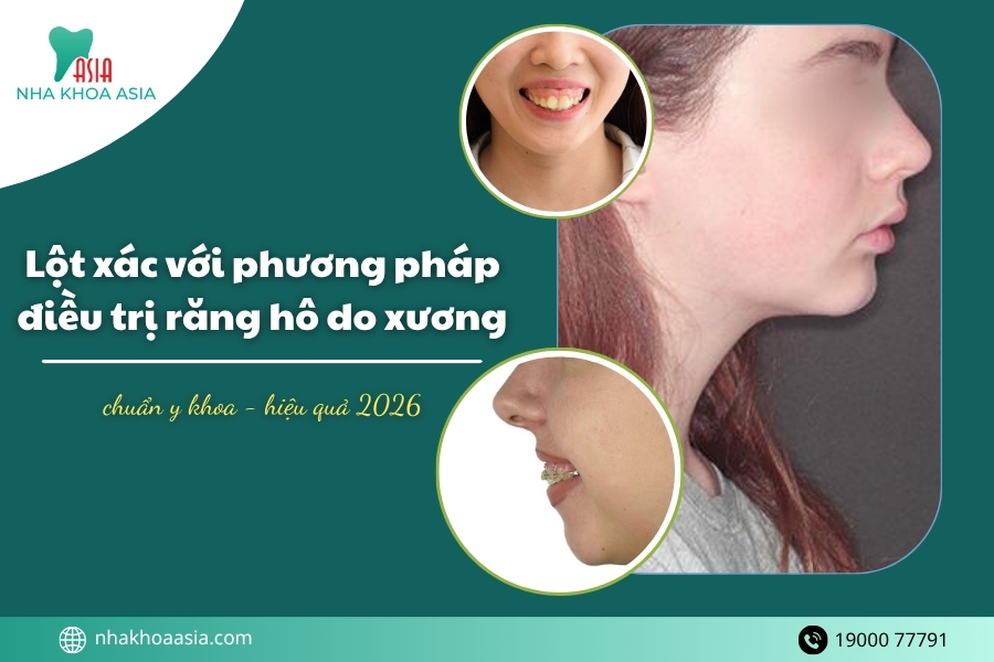 Lột xác với phương pháp điều trị răng hô do xương hiệu quả 2026