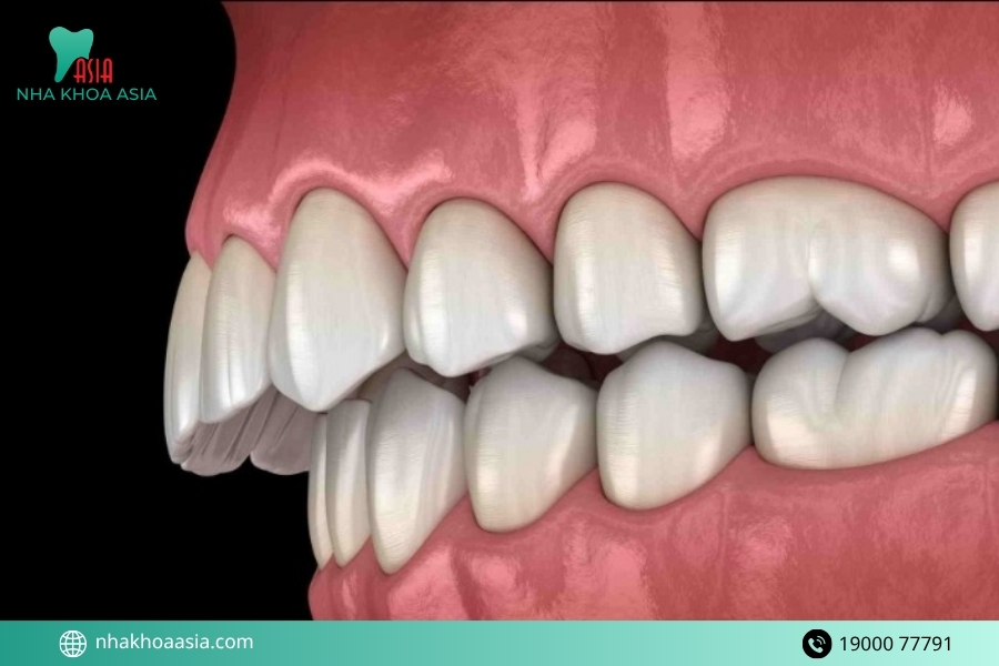 Răng hô do xương là gì? Cách nhận biết