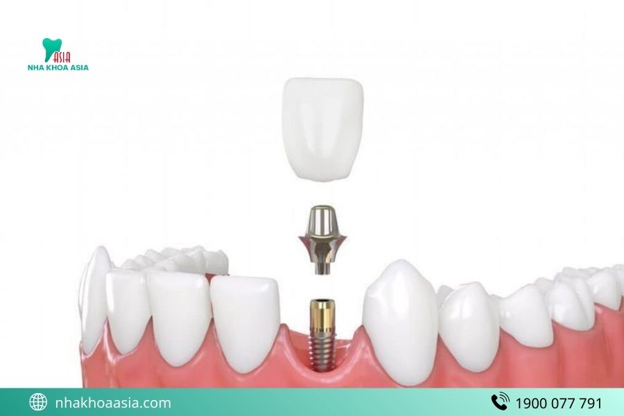 Răng Implant có ảnh hưởng kết quả chụp MRI khồng?