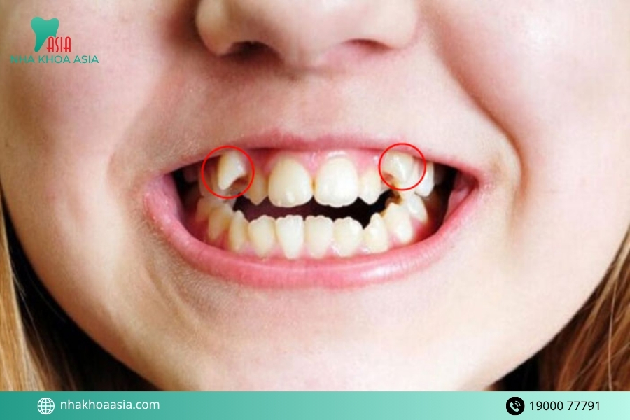 Răng khểnh là gì? Có nên niềng răng khểnh không?