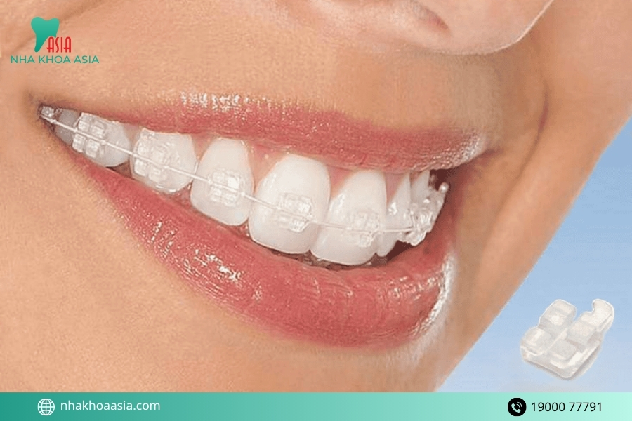 Niềng răng khểnh bằng mắc cài sứ