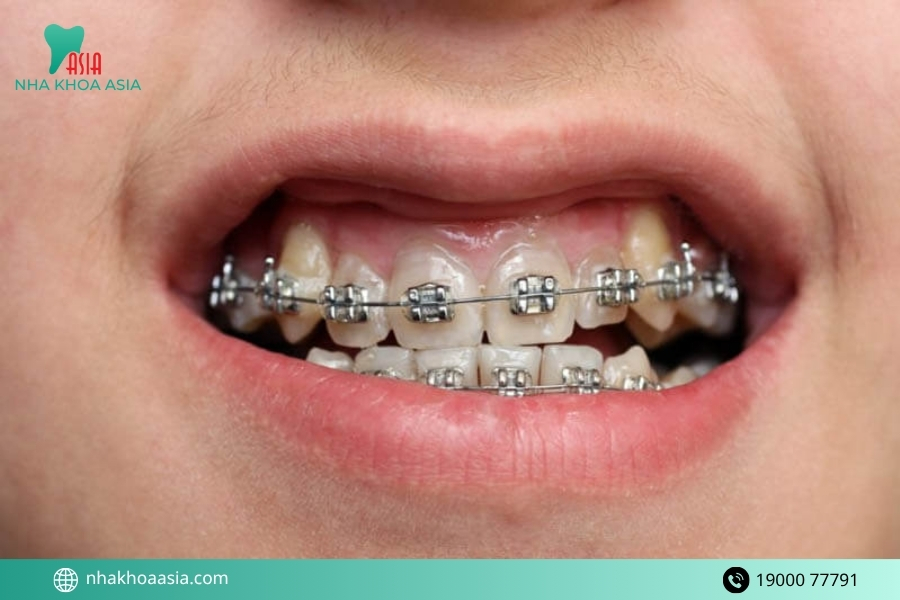 Những dấu hiệu cho thấy nên kiểm tra chỉnh nha