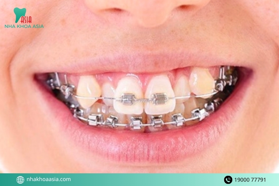 Niềng răng khểnh mang lại những thay đổi gì?