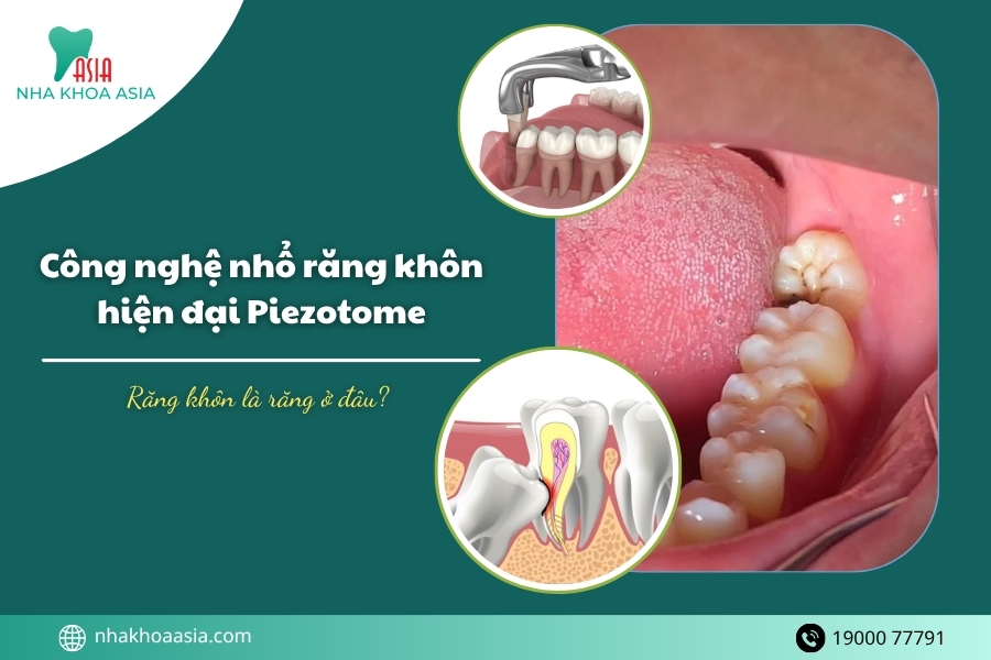 Răng khôn là răng ở đâu? Công nghệ nhổ răng khôn hiện đại không đau Piezotome