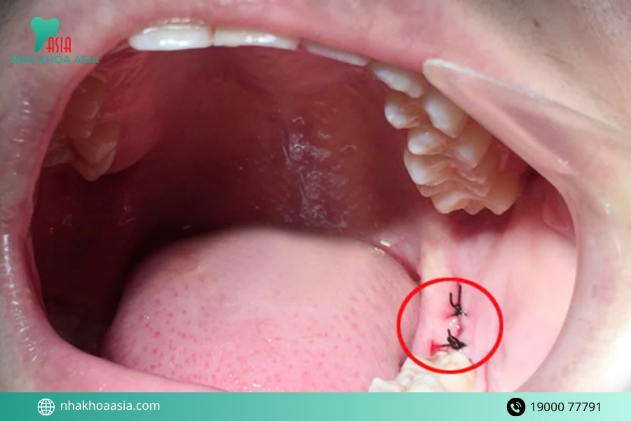  Răng khôn có nhất thiết phải nhổ không?