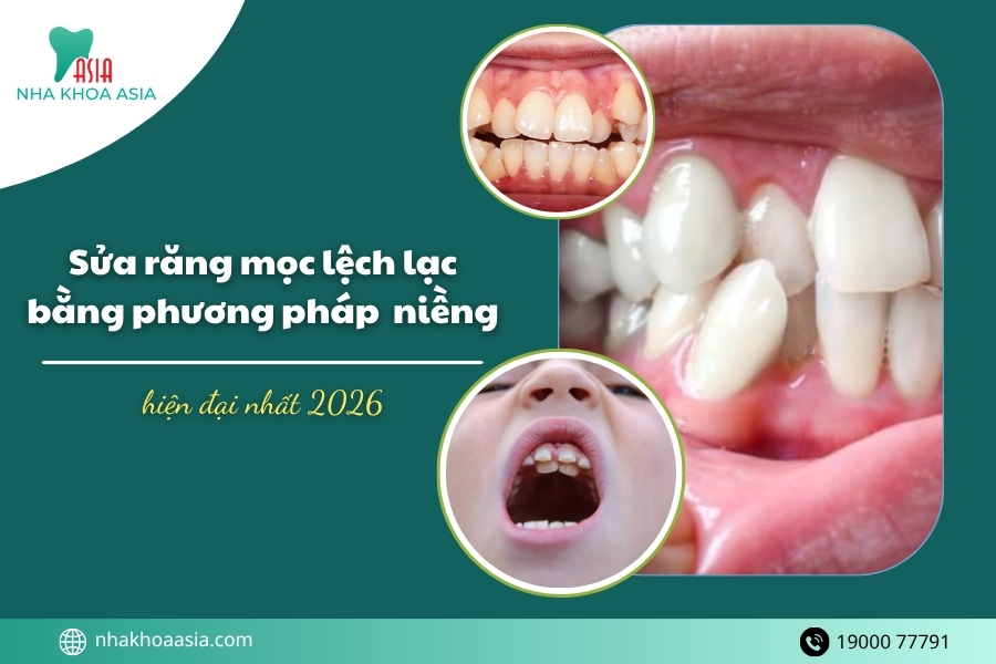 Sửa răng mọc lệch lạc bằng phương pháp niềng bằng hiện đại nhất 2026
