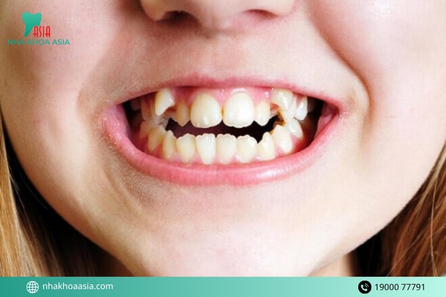 Các dạng răng mọc lệch lạc thường gặp