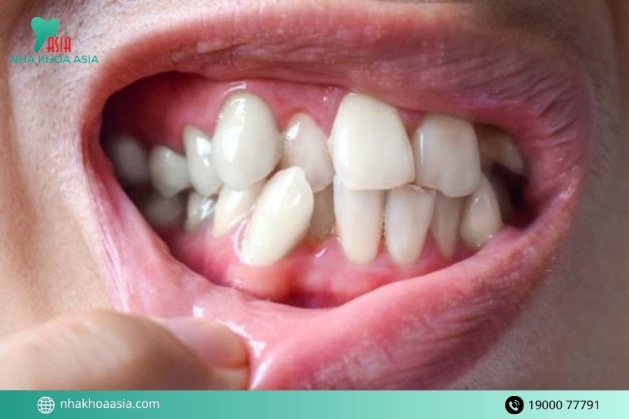 Nguyên nhân khiến răng mọc lệch lạc do đâu?