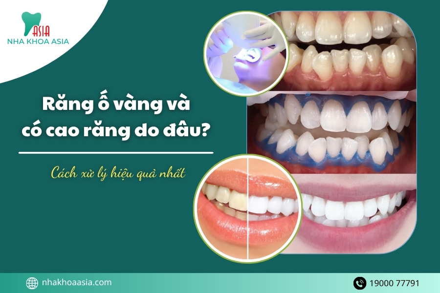 Răng ố vàng và có cao răng là tình trạng gì?