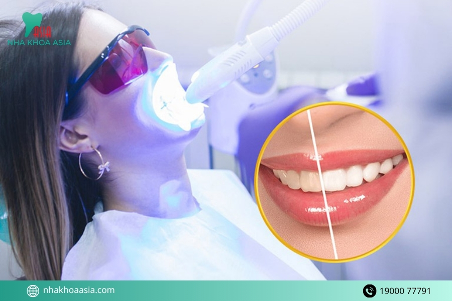 Tẩy trắng răng bằng đèn Laser whitening