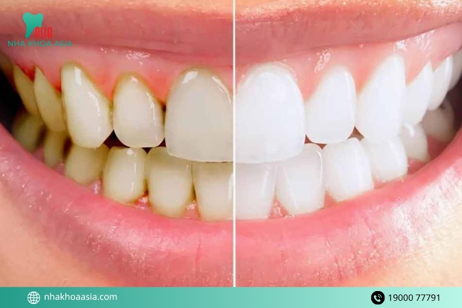 Lấy cao răng có giúp răng trắng hơn không?