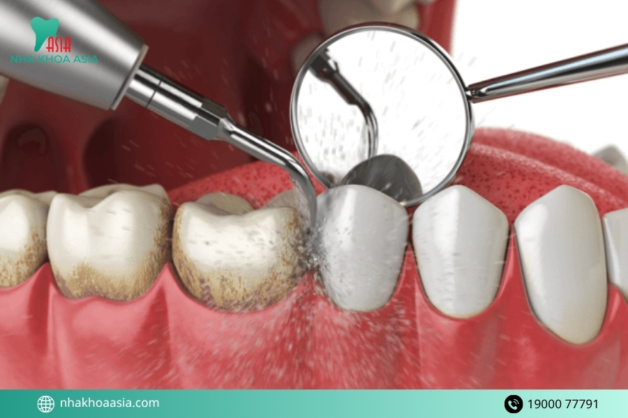 Răng ố vàng và có cao răng để lâu không xử lý dẫn đến hệ luỵ gì?  