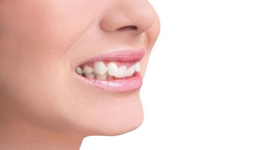 Tác hại của răng mọc quặp